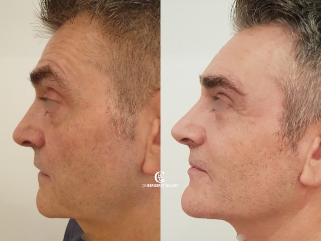 Lipofilling du visage