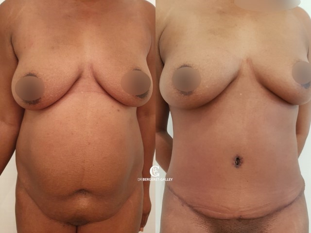 abdominoplastie