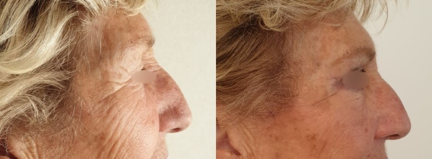 Avant/après une blépharoplastie : chirurgie des paupières