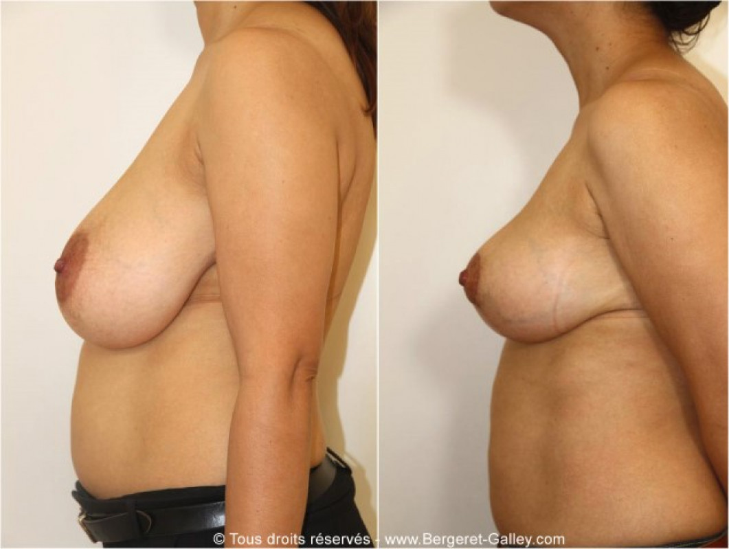 Breast reduction