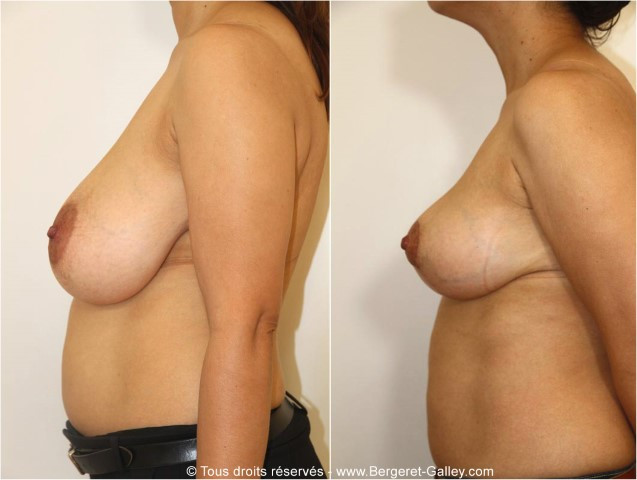 Breast reduction