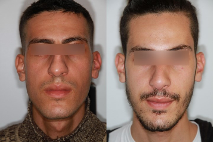 Before/After Rhinoplasty Paris