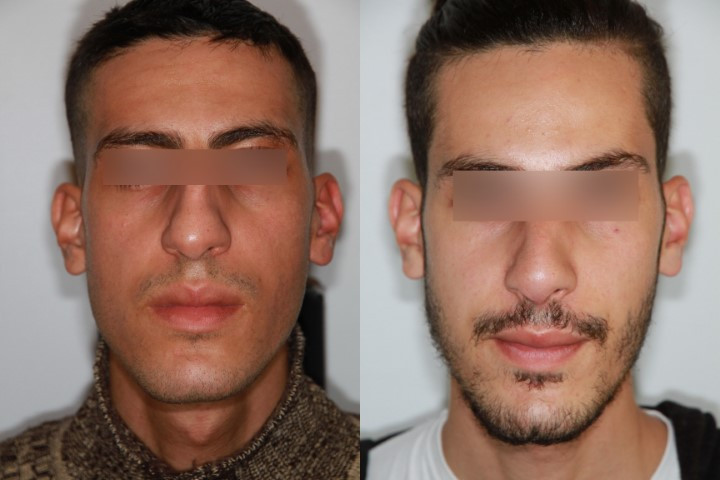 Résultat avant/après rhinoplastie