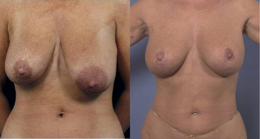 Mastopexy and breast augmentation