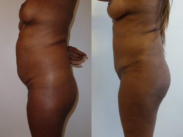 abdominoplastie