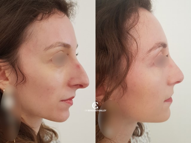 Résultat avant/après rhinoplastie