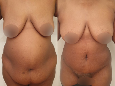 Abdominoplastie Avant/Après