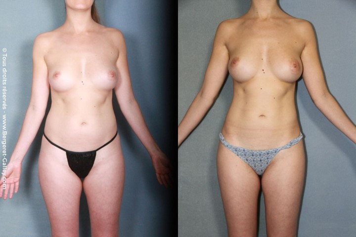 Lipofilling seins