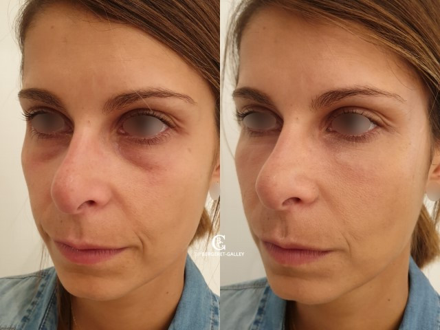 hyaluronic acid injections