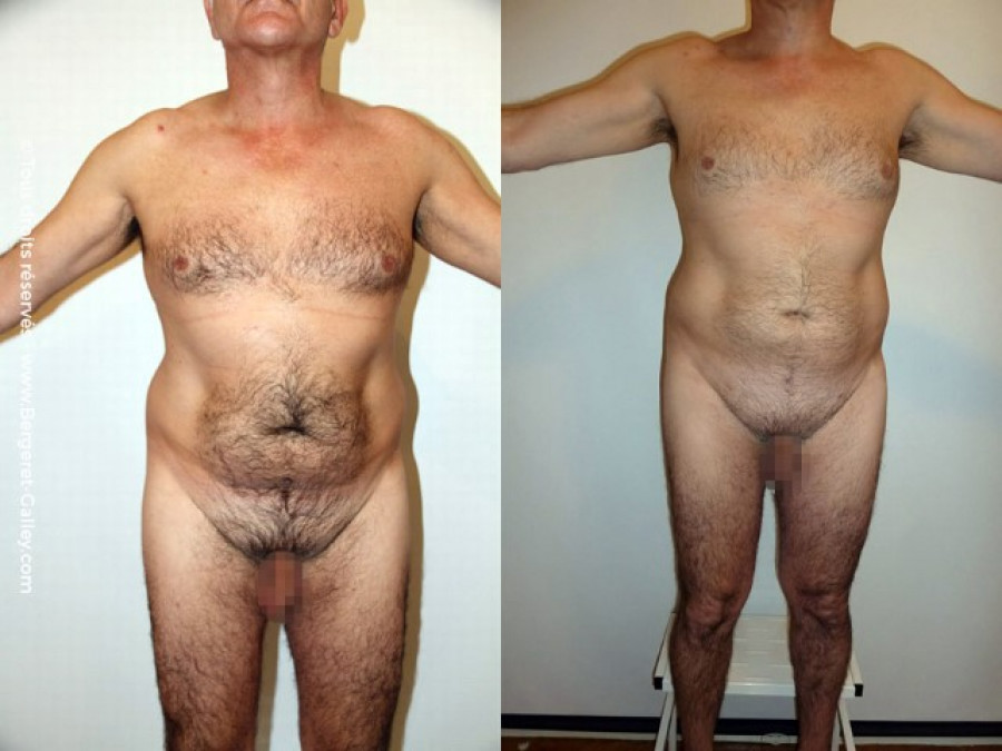 Liposuccion homme