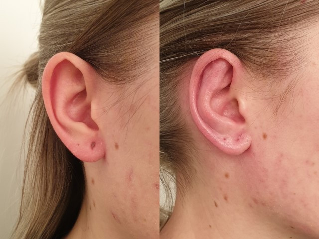 Otoplastie ou chirurgie des oreilles