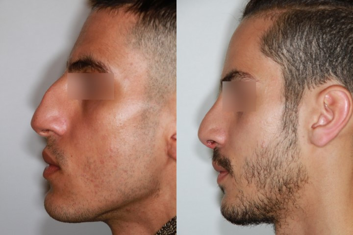 Résultat avant/après rhinoplastie