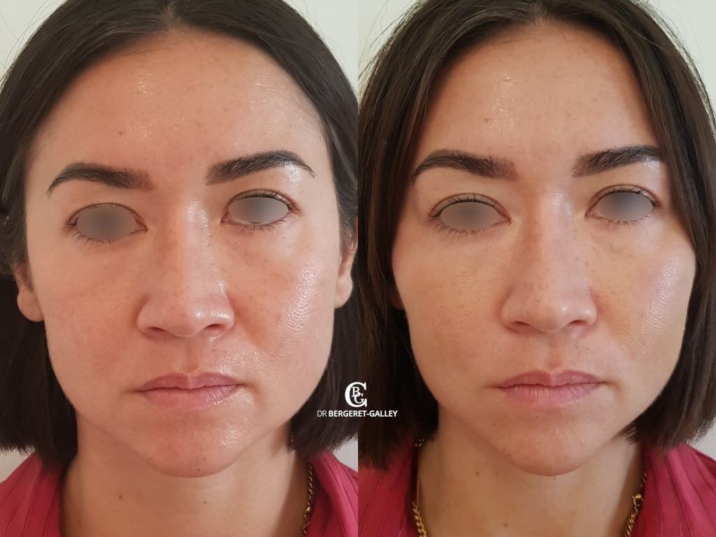 Injections hyaluronic acid