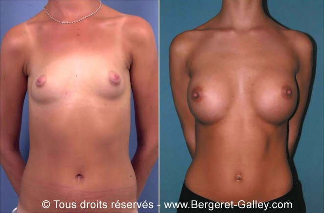 Mammary augmentation by implants