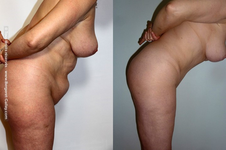 Abdominoplastie