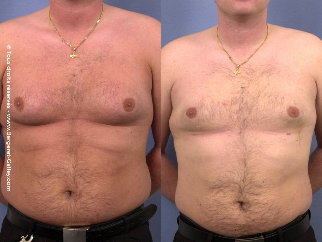 Lipoaspiration de Gynécomastie