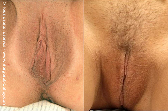 Косметическая интимная хирургия