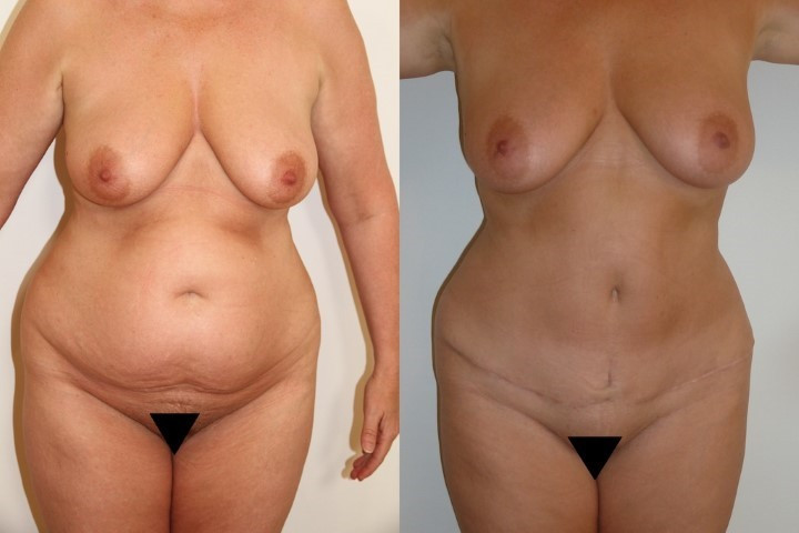 abdominoplastie