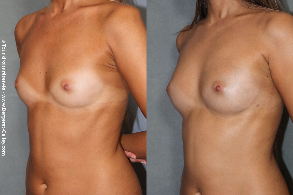 Lipofilling  breasts