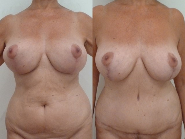 abdominoplastie