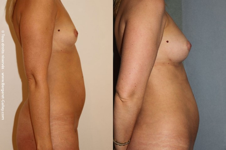 Lipofilling seins