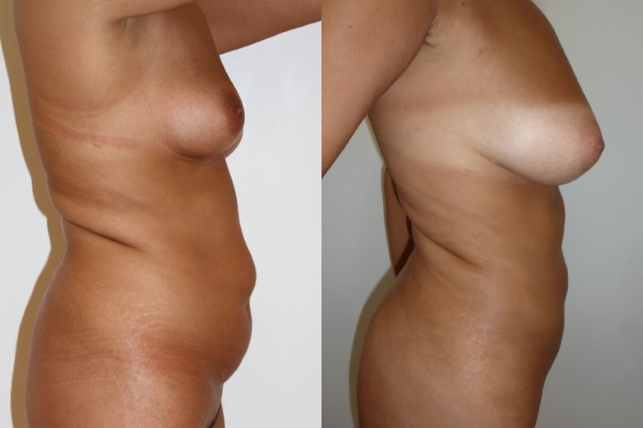 Lipofilling seins