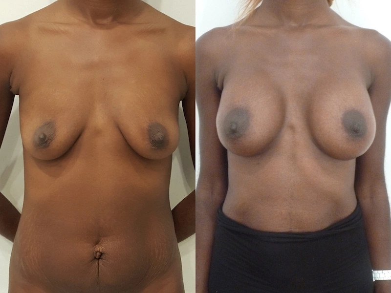 Photo avant/après augmentation mammaire avec des prothèses