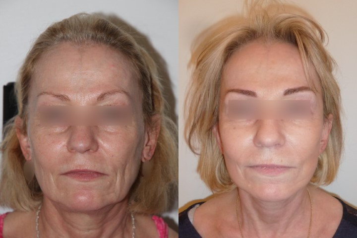 Lifting cervico-facial