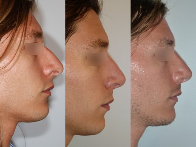 Résultat avant/après rhinoplastie