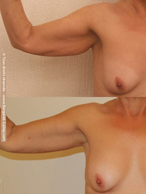 Brachioplasty