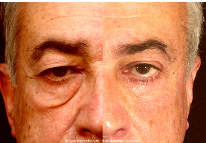 avant-apres Lifting ou blépharoplastie