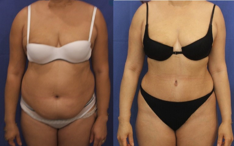 abdominoplastie