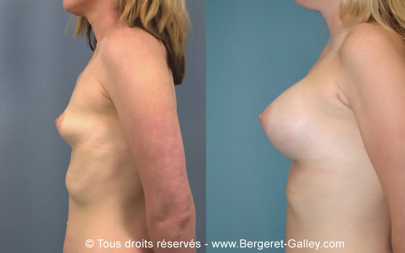 Photo avant/après augmentation mammaire avec des prothèses 350ml de profil