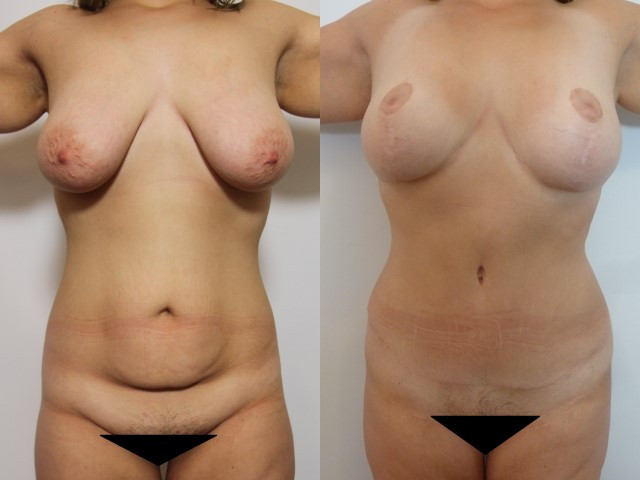 Chirurgie esthétique après la grossesse