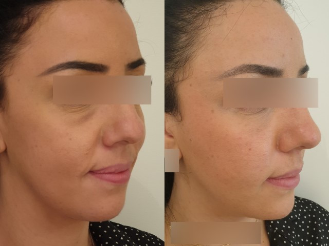 Lipofilling du visage