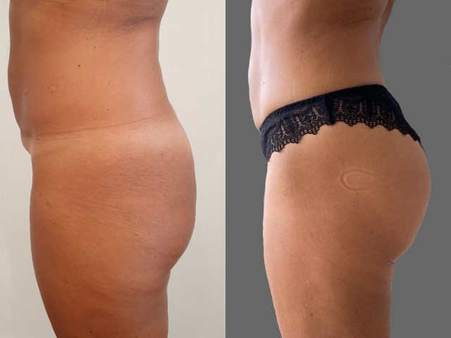 Profil Avant/Après augmentation fesses avec implants - Prothèses de fesses | Paris