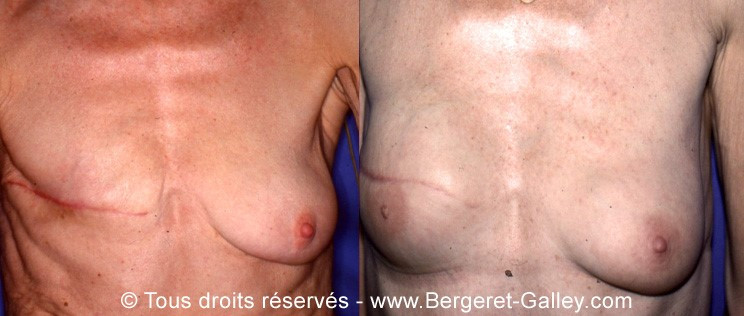 Before/After breast Reconstruction