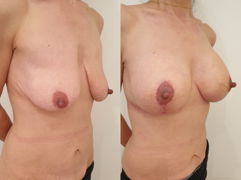 Лифтинг груди + имплантаты