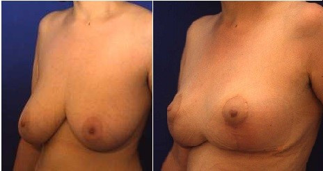 Breast reduction