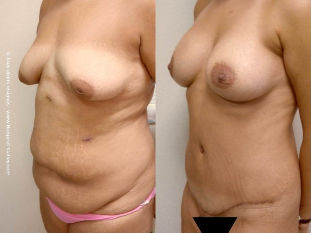 abdominoplastie chez une femme plusieurs grossesses