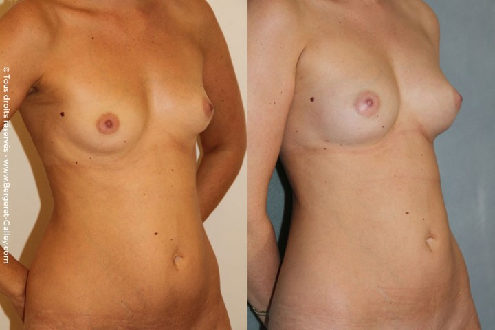 Lipofilling seins